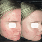 Acne + Sensitivity