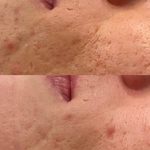 Acne Scars