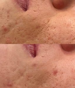 Acne Scars