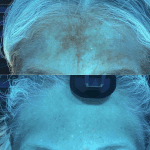Pigmentation