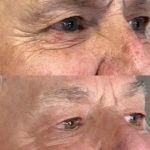 wrinkles