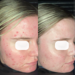 Acne scars