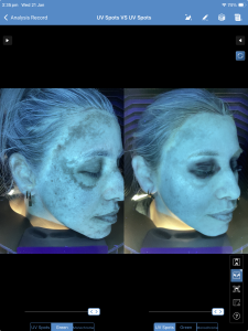 cosmelan 6 weeks Skin Scanner