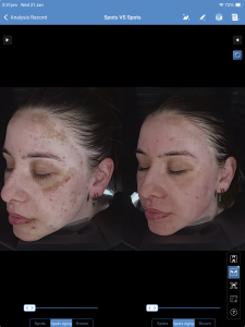 cosmelan 6 weeks Skin Scanner.png