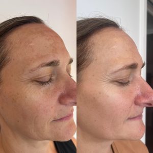 cosmelan 6 weeks side 1